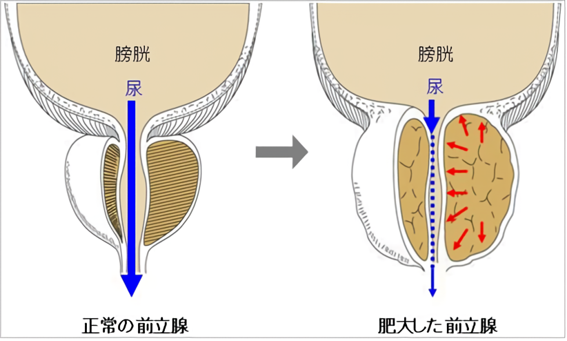 正常の前立腺と肥大した前立腺