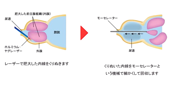 HoLEP治療の手順