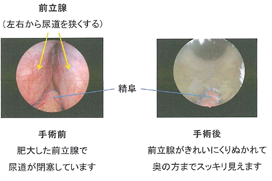 前立腺肥大症の内視鏡写真