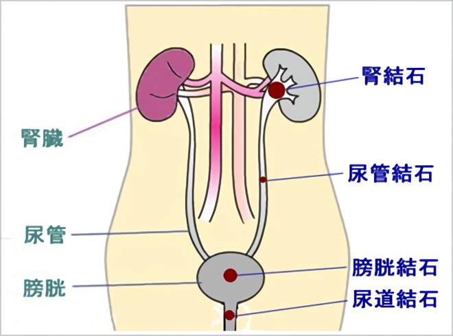 正常の前立腺と肥大した前立腺